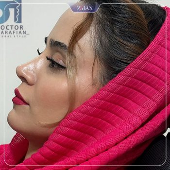 عکس جراحی زیبایی بینی توسط دکتر آرش شرفیان در تهران