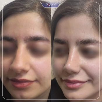 نمونه جراحی بینی دکتر محمودرضا اصحاب یمین