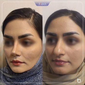 نمونه جراحی بینی دکتر محمودرضا اصحاب یمین