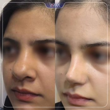 نمونه جراحی بینی دکتر محمودرضا اصحاب یمین