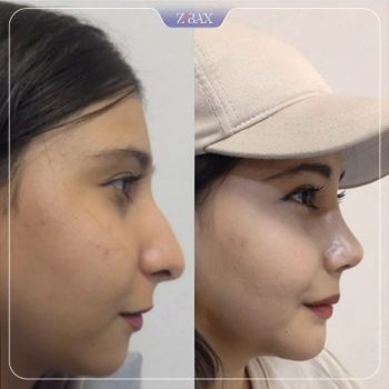 نمونه جراحی بینی دکتر محمودرضا اصحاب یمین