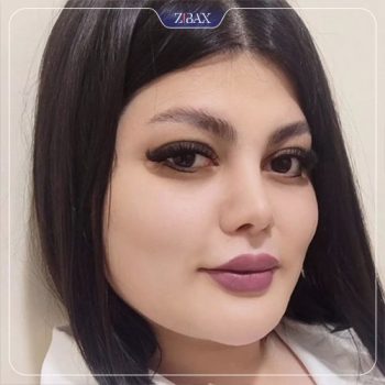 نمونه جراحی بینی دکتر محمودرضا اصحاب یمین