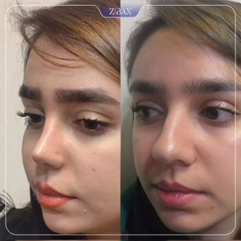 نمونه جراحی بینی دکتر محمودرضا اصحاب یمین
