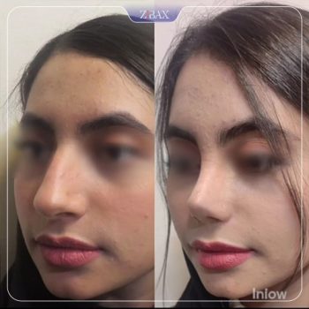 نمونه جراحی بینی دکتر محمودرضا اصحاب یمین