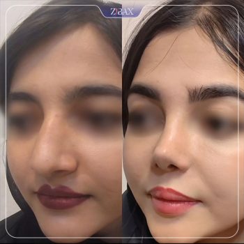 نمونه جراحی بینی دکتر محمودرضا اصحاب یمین