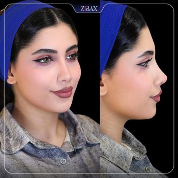 نمونه جراحی بینی دکتر مریم بحری در تهران