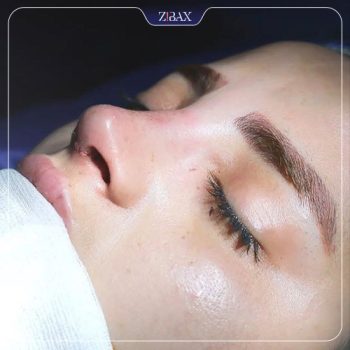 نمونه جراحی بینی دکتر مریم بحری در تهران