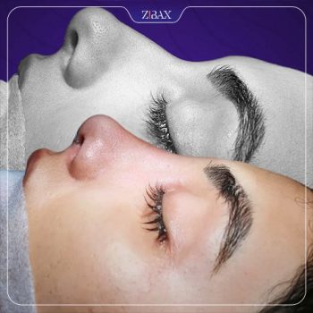 نمونه جراحی بینی دکتر مریم بحری در تهران