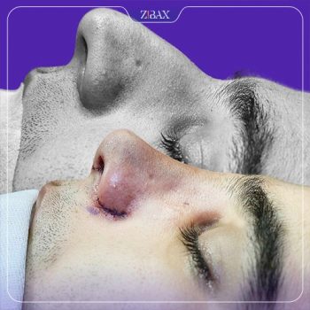 نمونه جراحی بینی دکتر مریم بحری در تهران