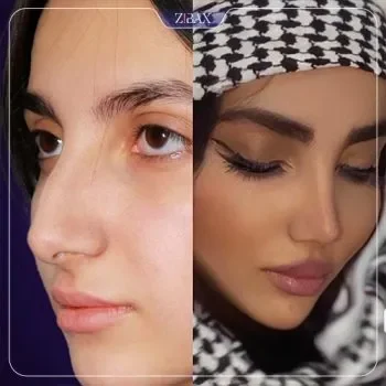 نمونه جراحی بینی دکتر بحری جراح بینی تهران