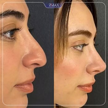 نمونه جراحی زیبایی بینی با دکتر محمد باقر بخشی پور در شیراز