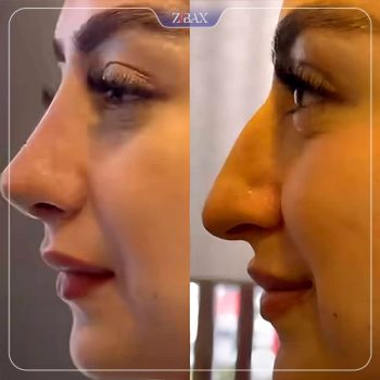 قبل و بعد عمل بینی با دکتر محمد باقر بخشی پور در شیراز