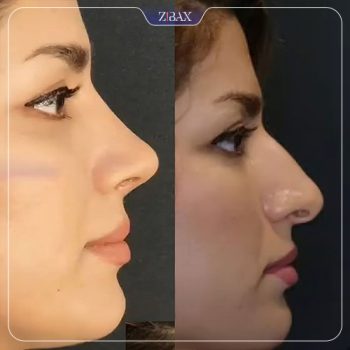 نمونه کار عمل زیبایی بینی توسط دکتر محمد باقر بخشی پور در شیراز