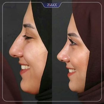 عکس نمونه عمل بینی با دکتر محمد باقر بخشی پور شیراز