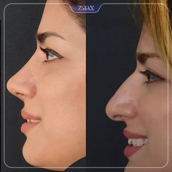 عکس قبل و بعد عمل زیبایی بینی با دکتر محمد باقر بخشی پور در شیراز