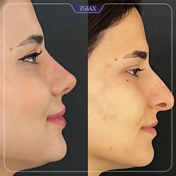 نمونه جراحی زیبایی بینی با دکتر محمد باقر بخشی پور در شیراز