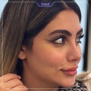 نمونه جراحی بینی توسط دکتر نیما برادران