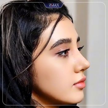 نمونه جراحی بینی توسط دکتر محمد بلاغی