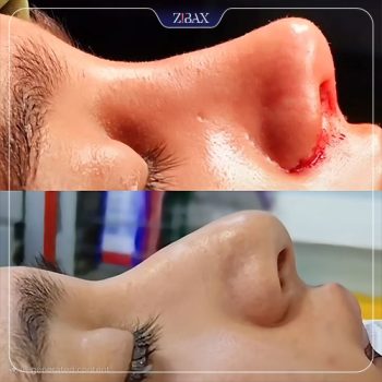 نمونه جراحی بینی توسط دکتر محمد بلاغی