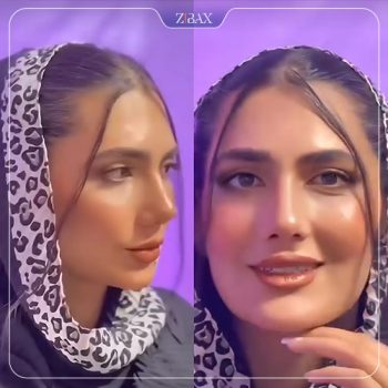 نمونه جراحی بینی توسط دکتر محمد بلاغی