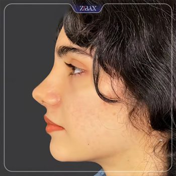 نمونه جراحی بینی توسط دکتر محمد بلاغی