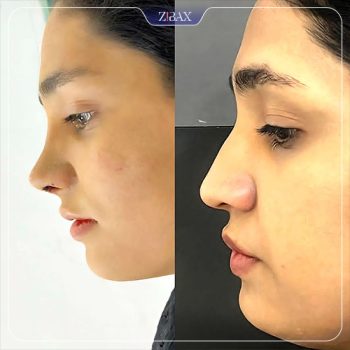 نمونه جراحی بینی توسط دکتر محمد بلاغی