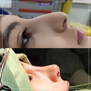 نمونه جراحی بینی توسط دکتر محمد بلاغی