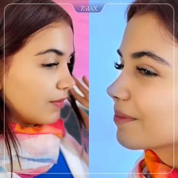 نمونه جراحی بینی توسط دکتر محمد بلاغی