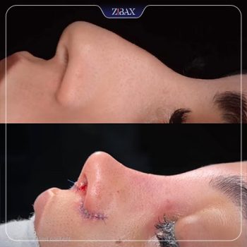 نمونه جراحی بینی با دکتر مسعود جانی پور در شیراز