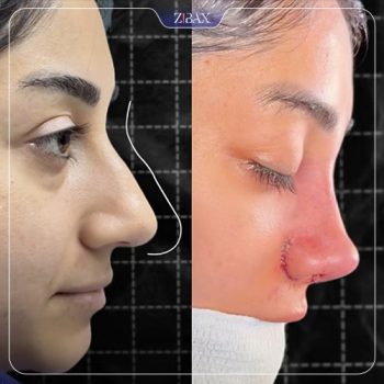 عکس نمونه کار جراحی بینی با دکتر مسعود جانی پور در شیراز