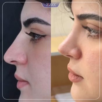 عکس جراحی زیبایی بینی توسط دکتر مسعود جانی پور در شیراز