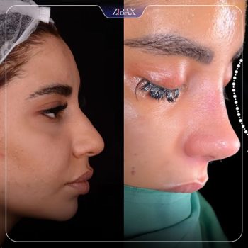 نمونه جراحی زیبایی بینی با دکتر مسعود جانی پور جراح بینی شیراز