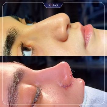 تصویر عمل زیبایی بینی با دکتر مسعود جانی پور در شیراز