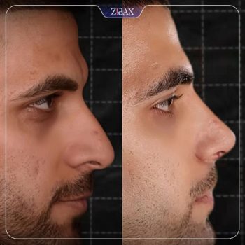 جراحی بینی با دکتر مسعود جانی پور در شیراز