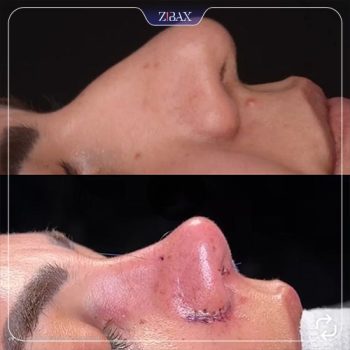 تصویر جراحی بینی توسط دکتر مسعود جانی پور در شیراز