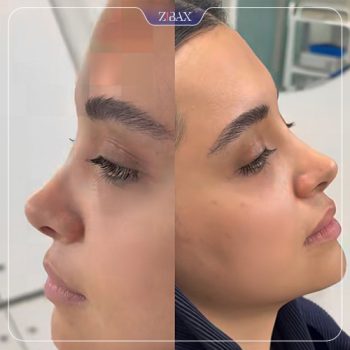 عکس نمونه کار جراحی بینی با دکتر مسعود حسن پور در تهران