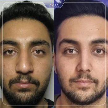 نمونه عمل زیبایی بینی دکتر مسعود رادمان