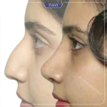 نمونه عمل زیبایی بینی دکتر مسعود رادمان