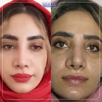 نمونه عمل زیبایی بینی دکتر مسعود رادمان