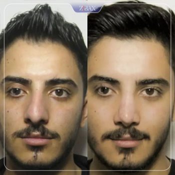 نمونه عمل زیبایی بینی دکتر مسعود رادمان