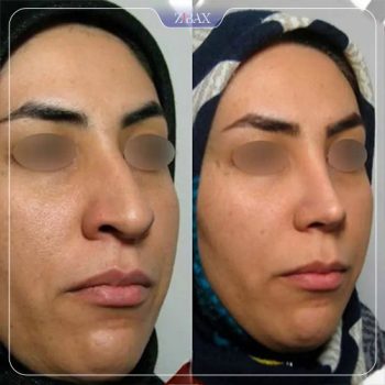 نمونه عمل زیبایی بینی دکتر مسعود رادمان