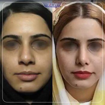 نمونه عمل زیبایی بینی دکتر مسعود رادمان