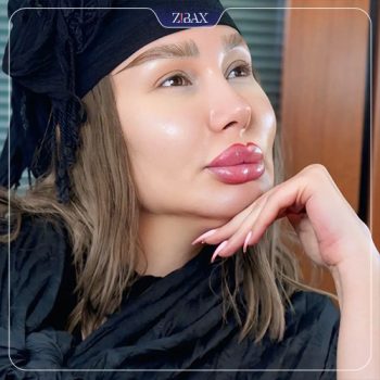 نمونه عمل بینی دکتر هادی سرمست