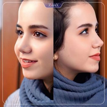 نمونه عمل بینی دکتر هادی سرمست