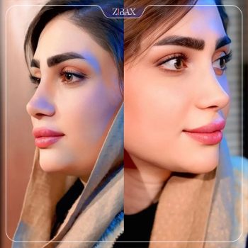 نمونه عمل بینی دکتر هادی سرمست