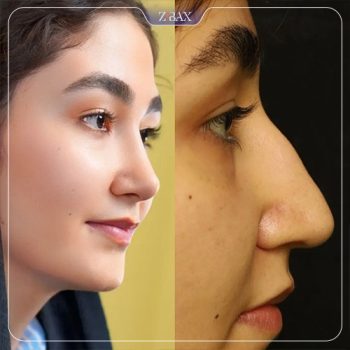 نمونه عمل بینی دکتر هادی سرمست