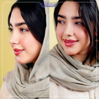 نمونه عمل بینی دکتر هادی سرمست