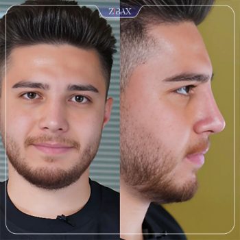 نمونه عمل بینی دکتر هادی سرمست