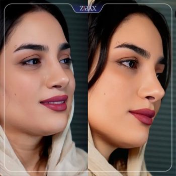 نمونه عمل بینی دکتر هادی سرمست