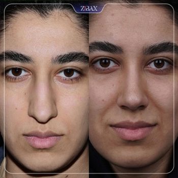 نمونه جراحی بینی با دکتر شاهین باستانی نژاد در تهران